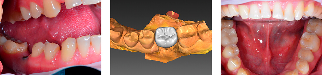 Имплантация зубов «Все-на-6»: стоматологи рассказали, что важно знать об этом методе
